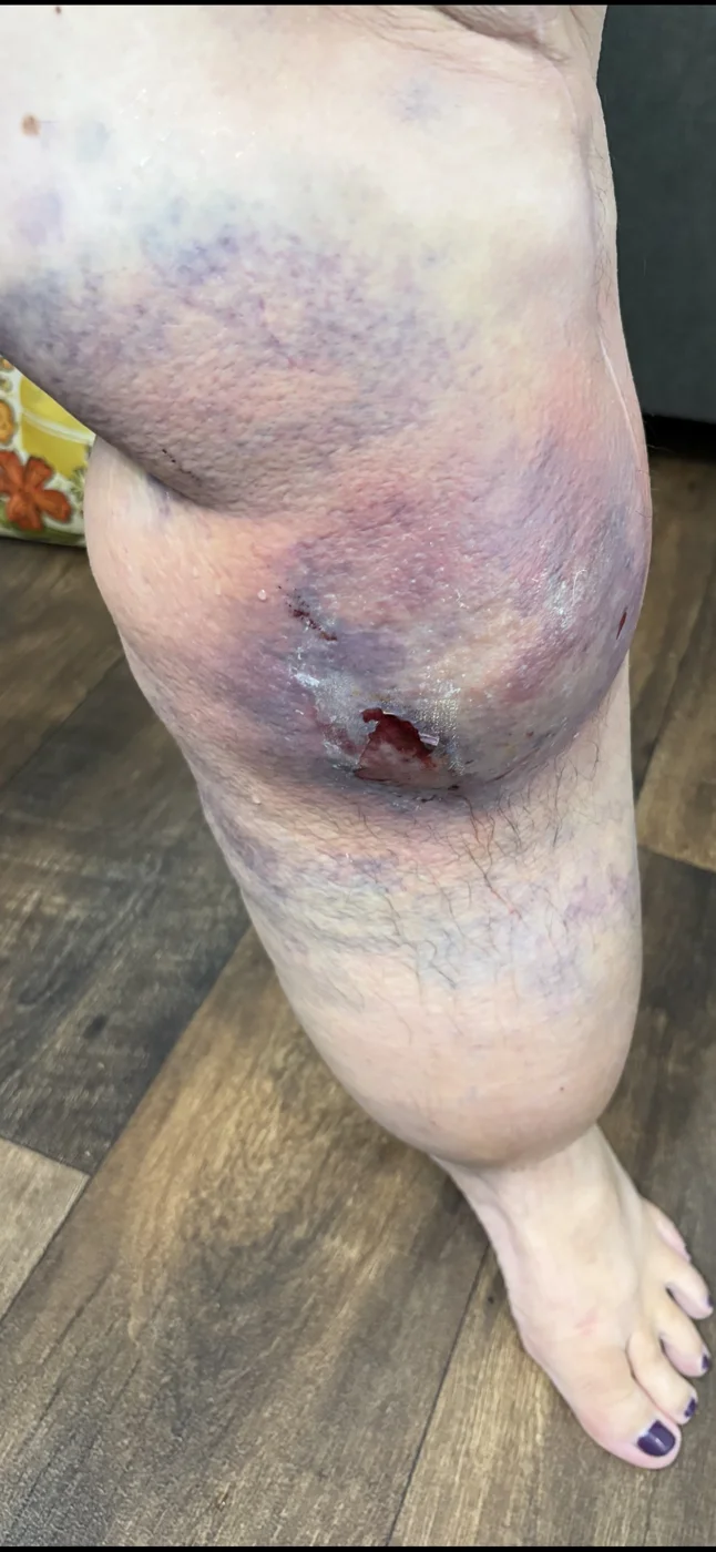 Traumatic calf wound after injury
