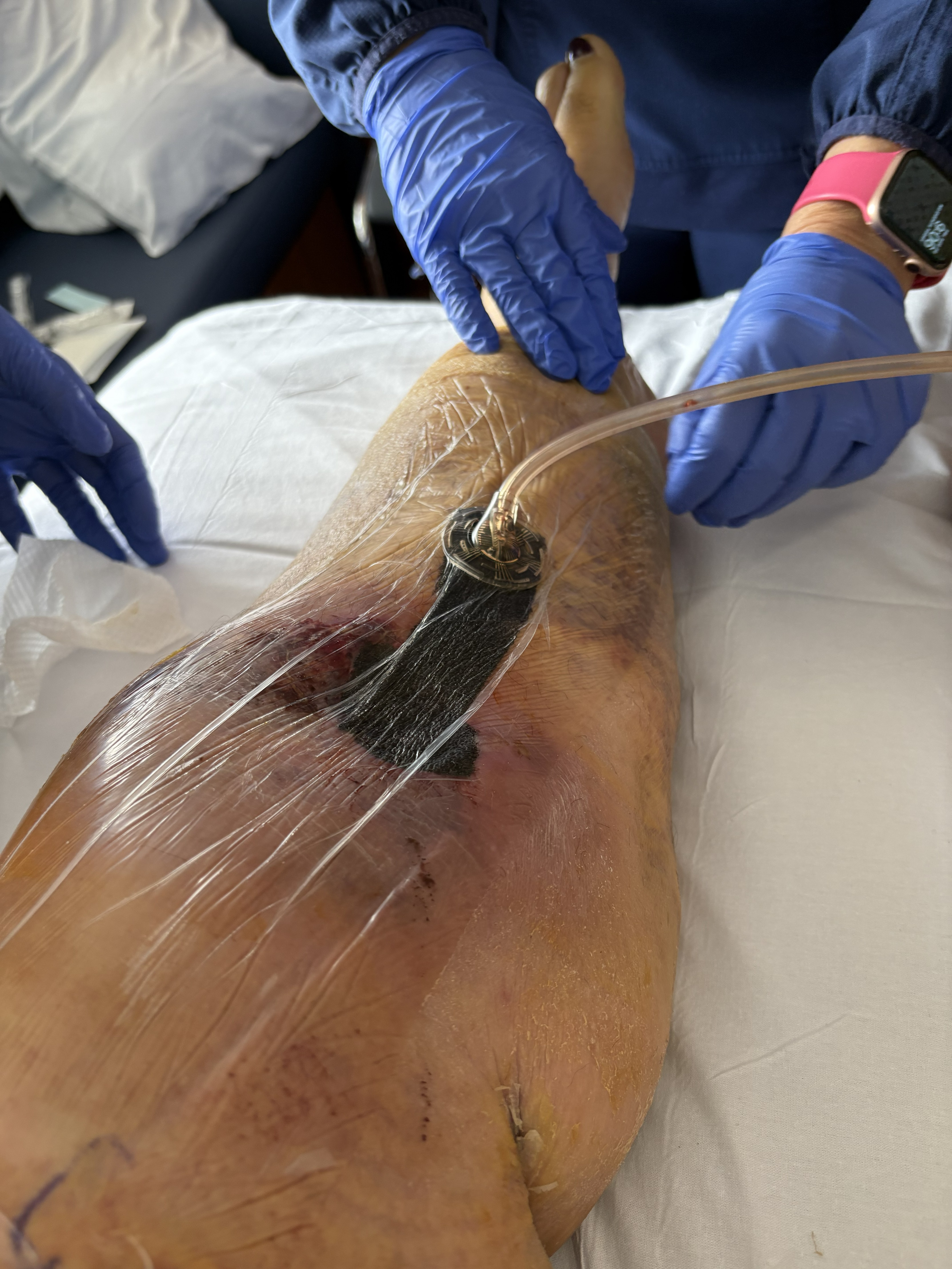 Calf wound healing after surgery