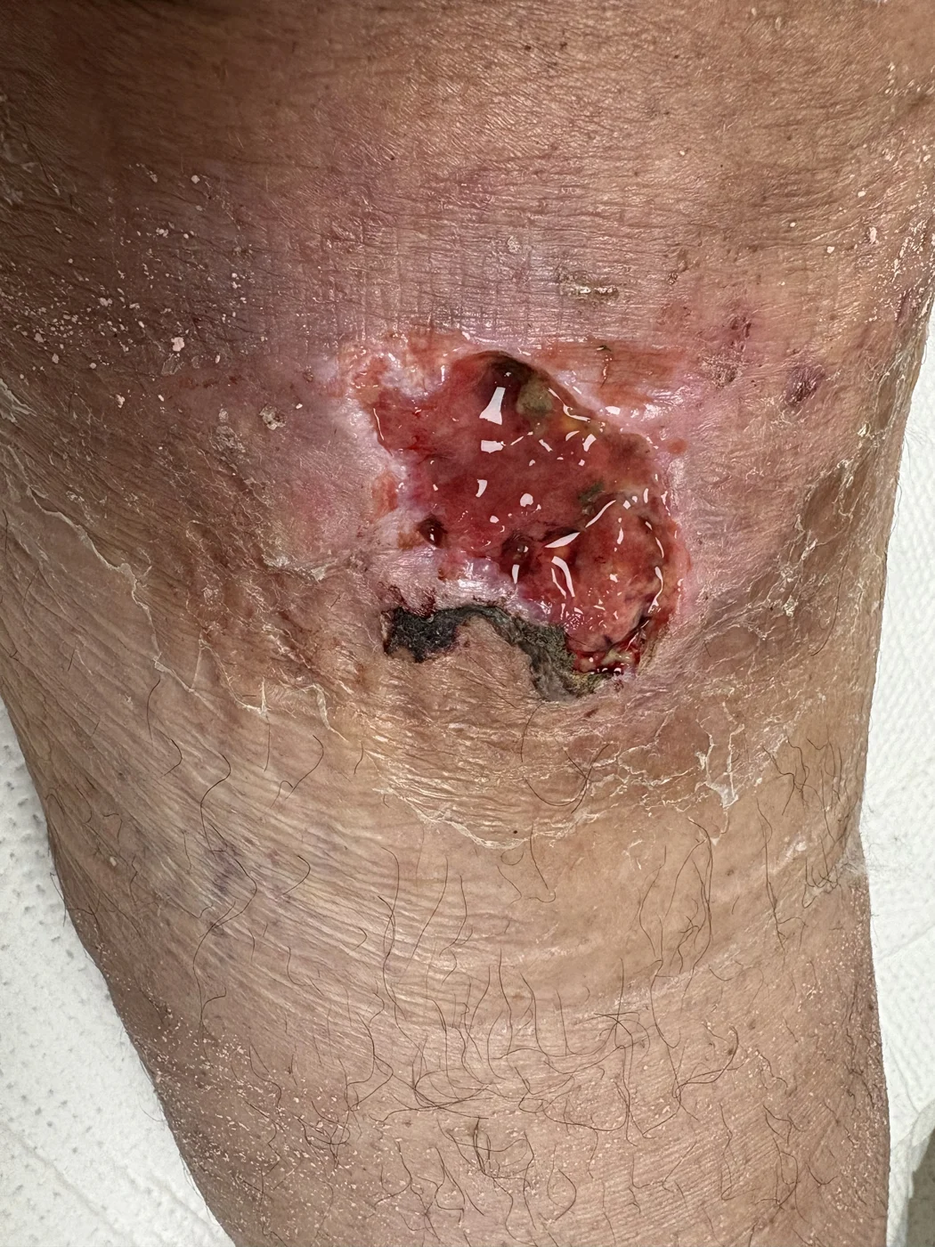 Recovered calf wound