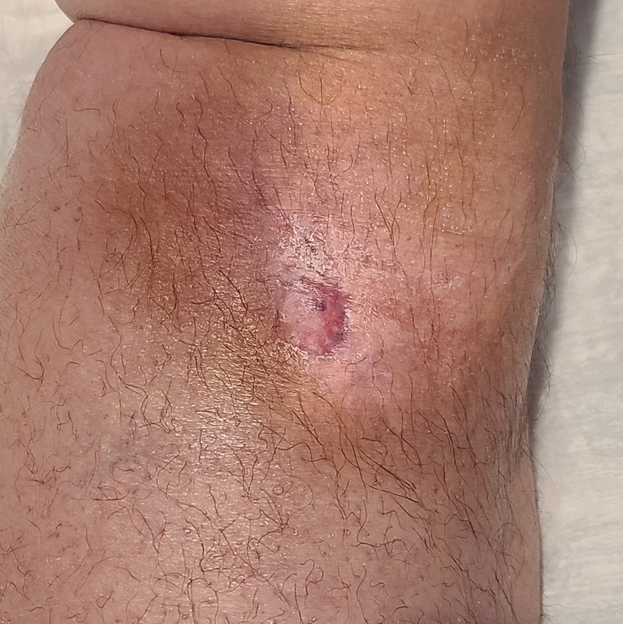 Calf wound fully healed