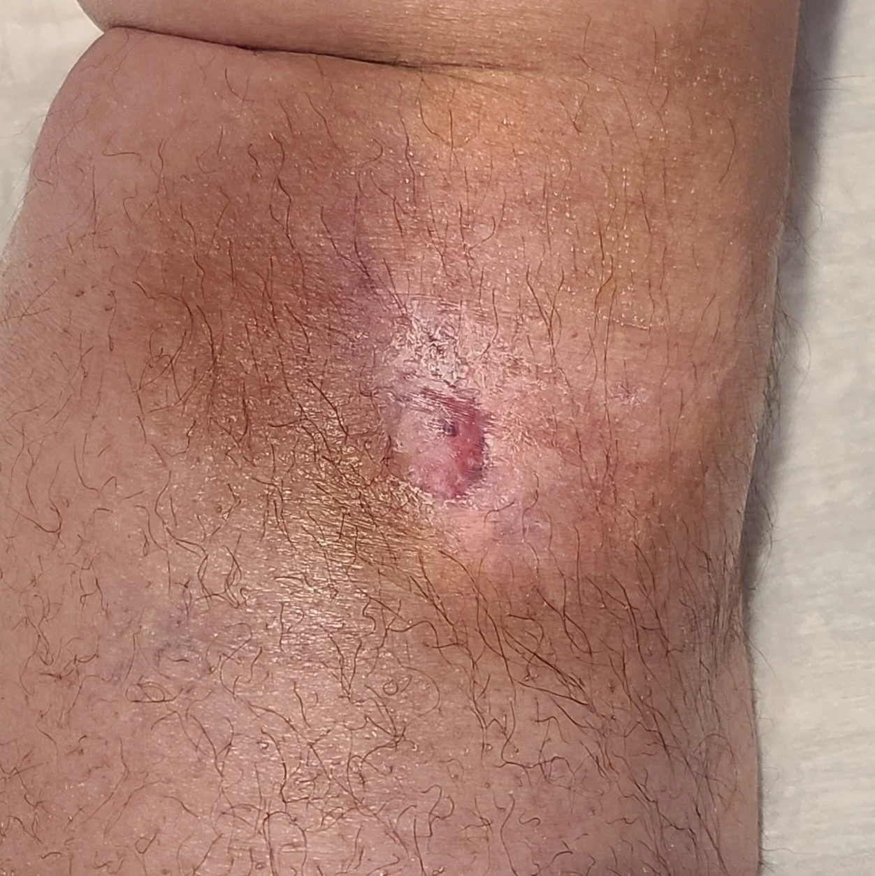 Calf wound fully healed
