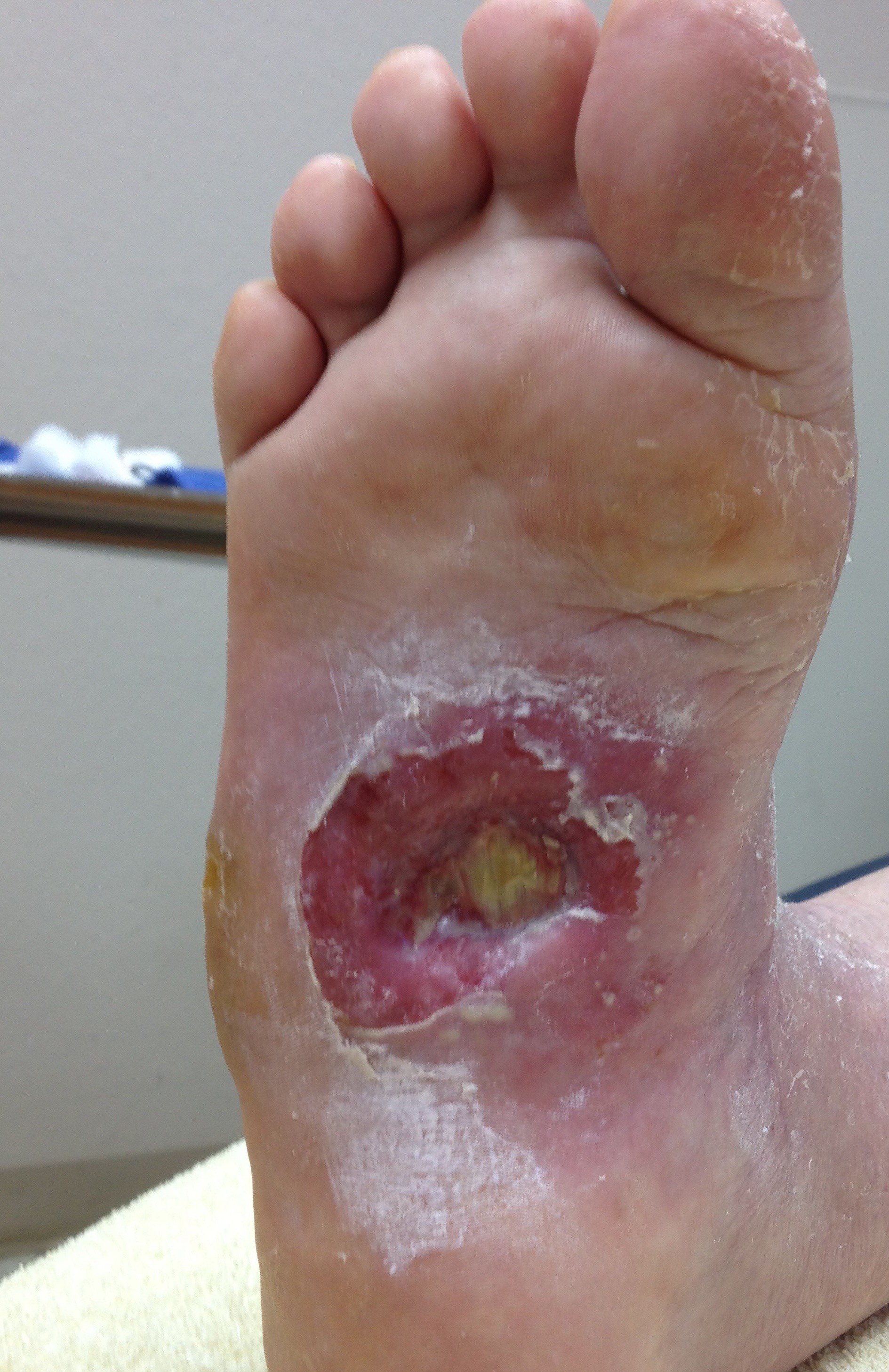 Initial plantar foot ulcer