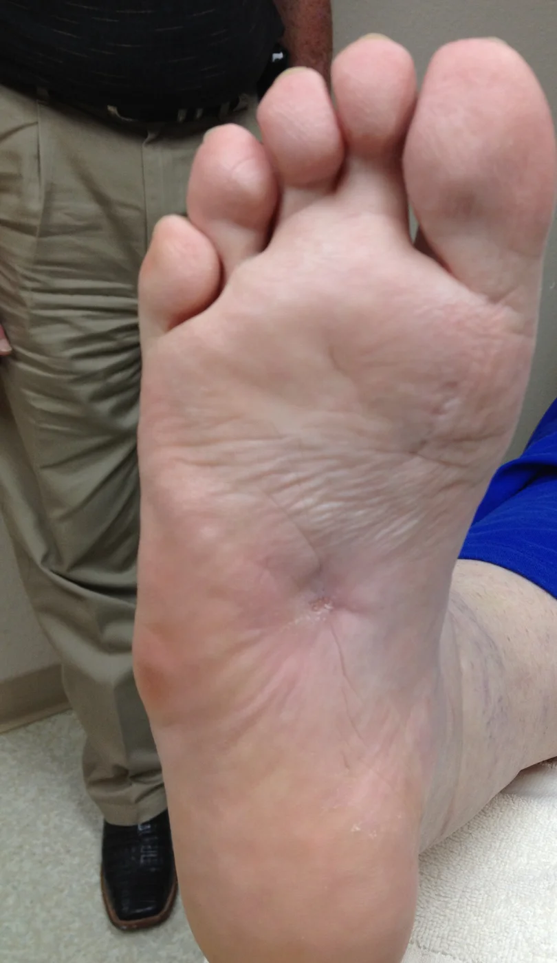 Healed plantar ulcer
