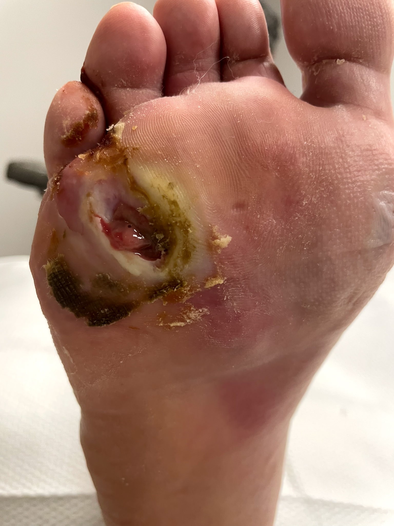 Wound before specialty care