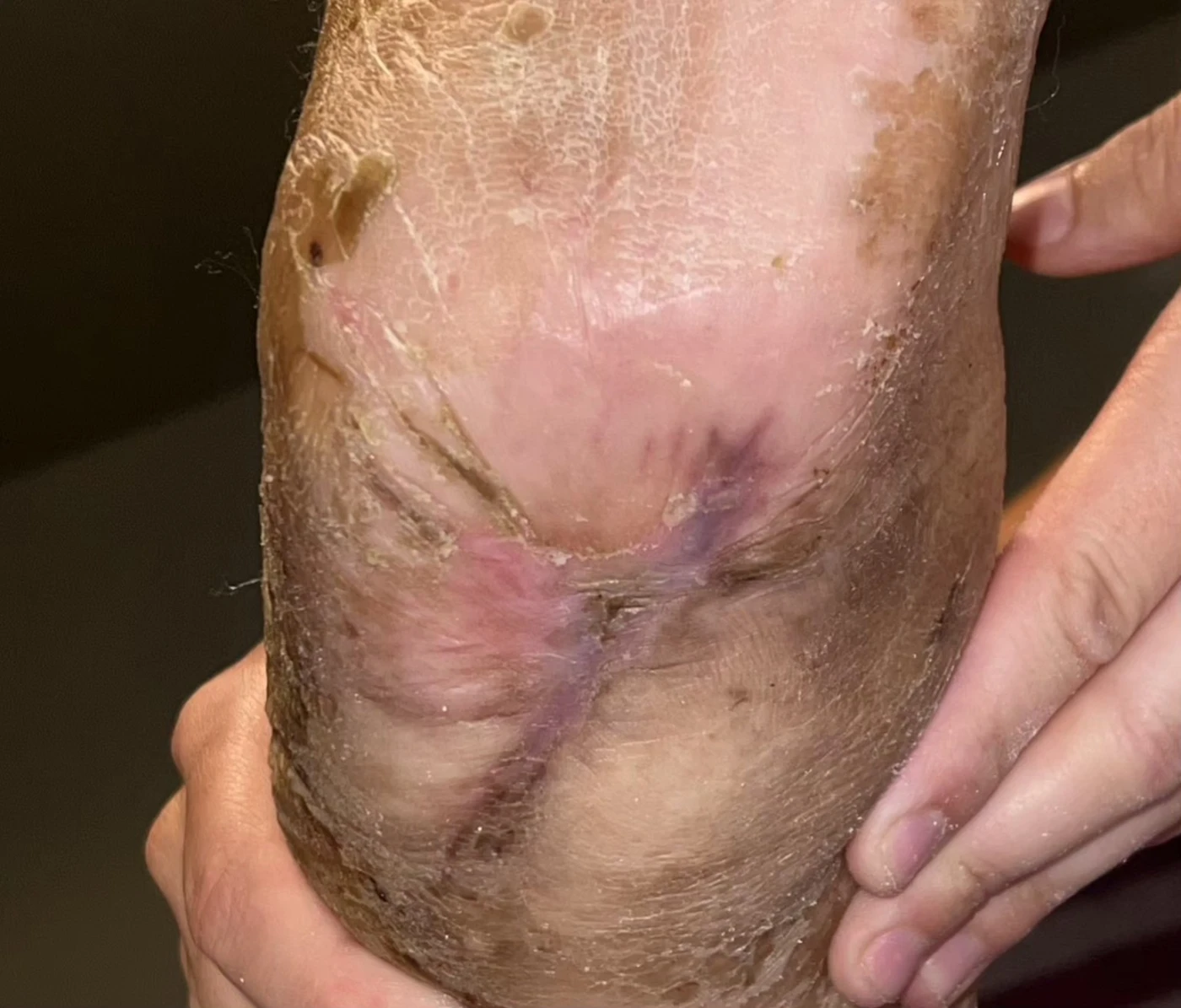 Healed left heel diabetic foot ulcer, September 30, 2026