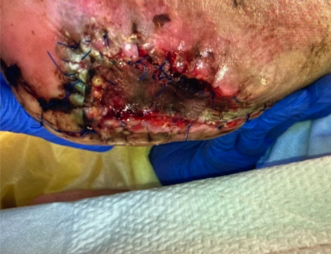 Left heel diabetic foot ulcer before serial office treatment, June 1, 2026